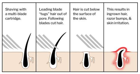 smartshave ingrown hairs